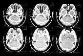 image of scan  - ct scan of 30 year old male skull and brain - JPG 